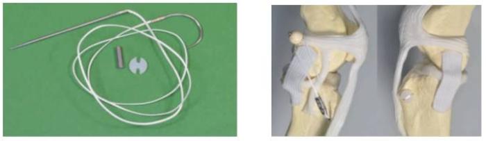 LigaFiba lateral button suture 75lb, LFLBS75TI - Jan F Andersen